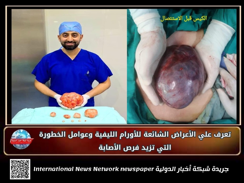 جريدة شبكة أخبار الدولية : تعرف علي الأعراض الشائعة للأورام الليفيةوعوامل الخطورة التي تزيد فرص&nbsp;الأصابة